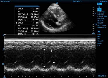 echo lv wall segments|ejection fraction vs fractional shortening.